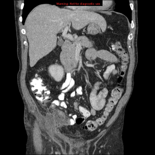 File:Appendicitis mass in inguinal hernia (Radiopaedia 26858-27029 B 25).jpg