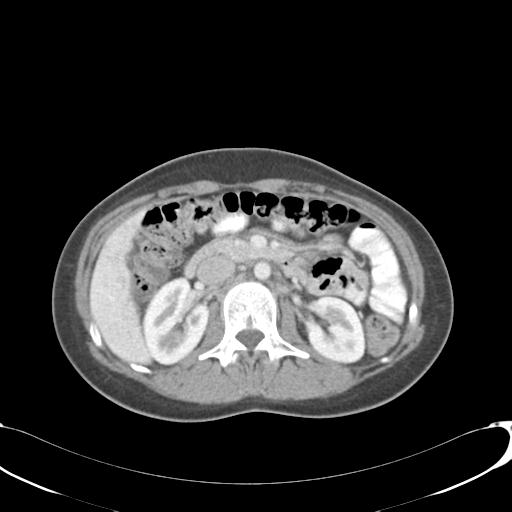 File:Appendicitis with minimal stranding but appendicolith (Radiopaedia 29035-29397 A 33).jpg