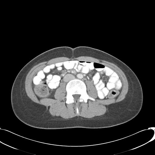 Appendicitis with minimal stranding but appendicolith (Radiopaedia 29035-29397 A 46).jpg