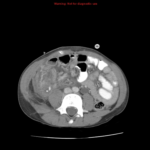 File:Appendicitis with phlegmon (Radiopaedia 9358-10046 A 43).jpg