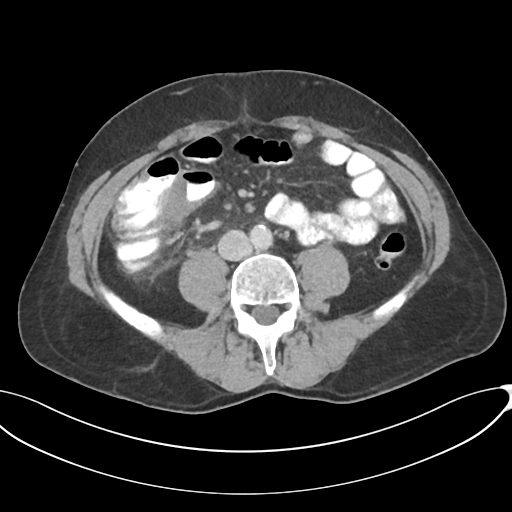 Appendicitis with thickening of the terminal ileum (Radiopaedia 42432-45550 A 60).png