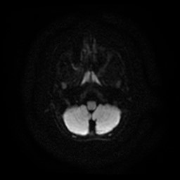 Arachnoid cyst - middle cranial fossa (Radiopaedia 86780-102938 Axial DWI 25).jpg