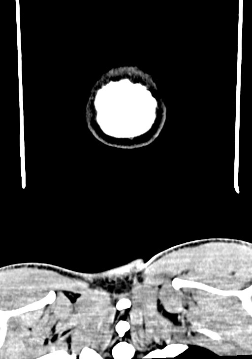 Arrow injury to the brain (Radiopaedia 72101-82607 Coronal non-contrast 72).jpg