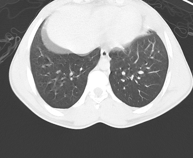 File:Arrow injury to the chest (Radiopaedia 75223-86321 Axial lung window 69).jpg