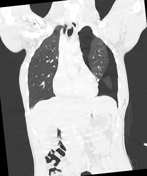 Arrow injury to the chest (Radiopaedia 85367-100975 Coronal lung window 66).jpg