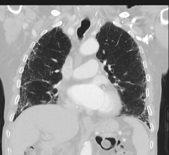 Asbestosis (Radiopaedia 56192-62864 Coronal lung window 24).png