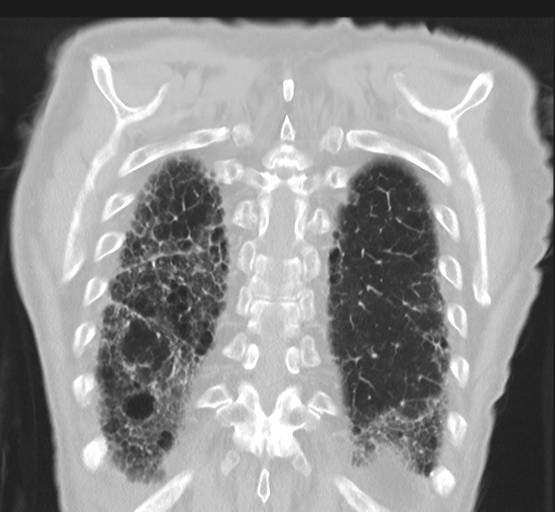 Asbestosis (Radiopaedia 56192-62864 Coronal lung window 44).png