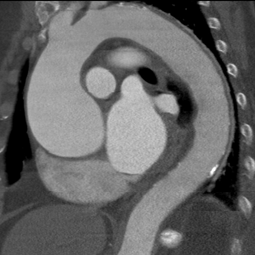File:Ascending aortic aneurysm (Radiopaedia 20913-20846 A 18).jpg