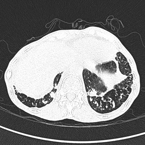 Aspergilloma- with Monod sign (Radiopaedia 44737-48532 Axial lung window 271).jpg