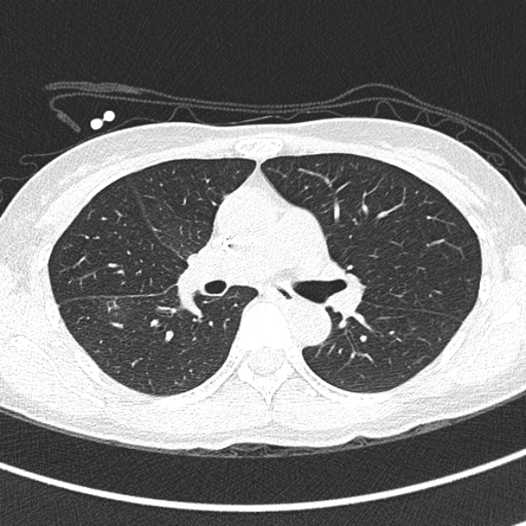 Aspergilloma (Radiopaedia 26223-26347 Axial lung window 36).jpg