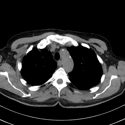 Aspergilloma on background pulmonary fibrosis (Radiopaedia 60942-68757 Axial non-contrast 16).jpg