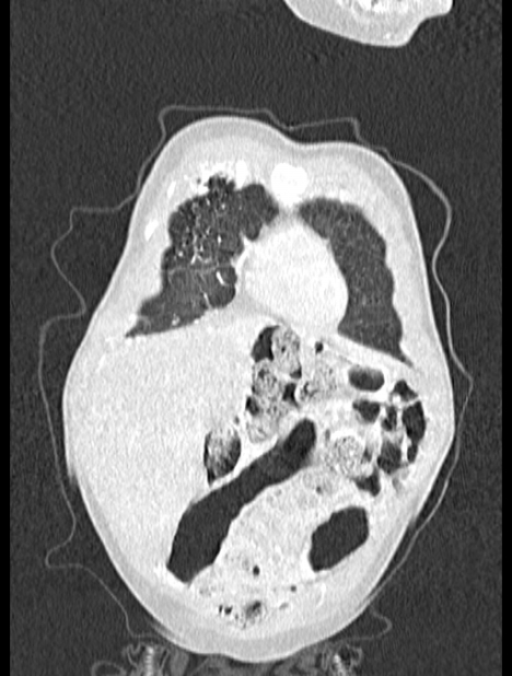 Asplenia syndrome (Radiopaedia 73083-83792 Coronal lung window 13).jpg