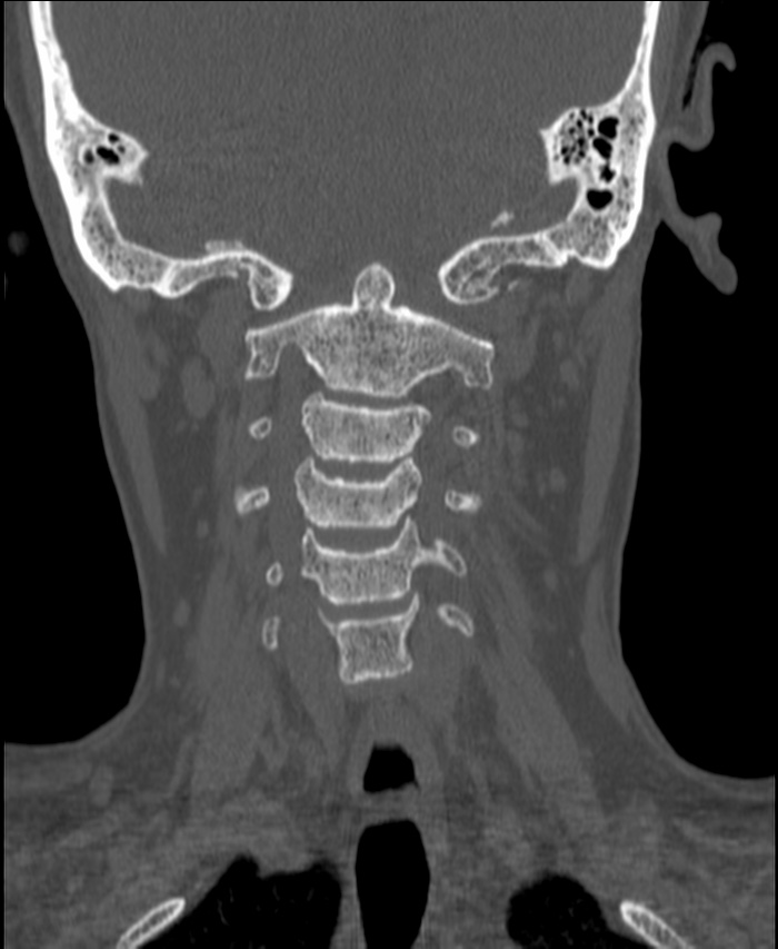 Atlanto-occipital assimilation with basilar invagination (Radiopaedia 70122-80188 Coronal bone window 99).jpg