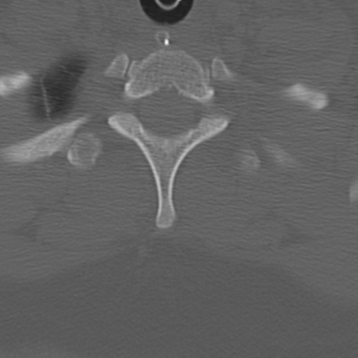 Atlanto-occipital dissociation (Radiopaedia 33848-35013 Axial bone window 45).png