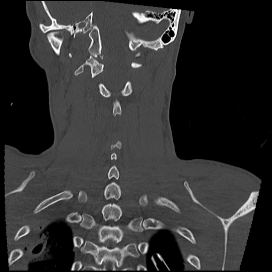 Atlanto-occipital dissociation (Traynelis type 1), C2 teardrop fracture, C6-7 facet joint dislocation (Radiopaedia 87655-104061 Coronal bone window 50).jpg