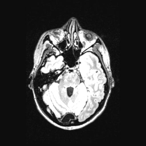 Atretic encephalocoele with inferior vermis hypoplasia (Radiopaedia 30443-31108 Axial 52).jpg