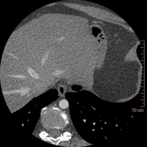 Atrial septal defect (upper sinus venosus type) with partial anomalous pulmonary venous return into superior vena cava (Radiopaedia 73228-83961 A 270).jpg