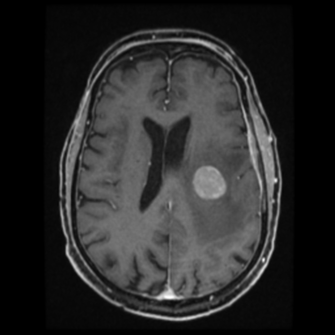 Atypical meningioma (Radiopaedia 45535-49629 Axial T1 C+ 44).jpg