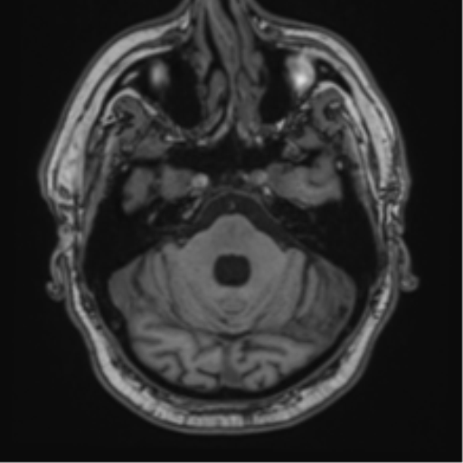 File:Atypical meningioma (WHO grade II) with brain invasion (Radiopaedia 57767-64729 Axial T1 12).png