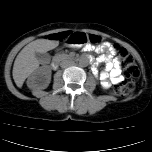 File:Atypical renal cyst (Radiopaedia 17536-17251 non-contrast 21).jpg