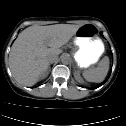 File:Atypical renal cyst (Radiopaedia 17536-17251 non-contrast 4).jpg