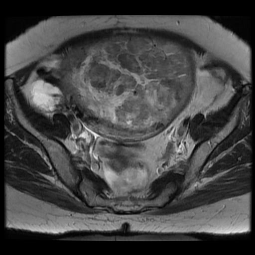 File:Atypical retroperitoneal lymphocoeles with large leiomyoma of uterus (Radiopaedia 32084-33027 Axial T2 18).jpg