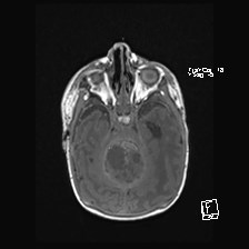 File:Atypical teratoid rhabdoid tumor (prenatal US and neonatal MRI) (Radiopaedia 59091-66388 Axial T1 20).jpg