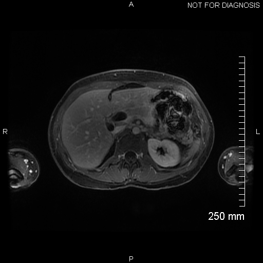 Autoimmune pancreatitis (Radiopaedia 88443-105101 A 58).jpg