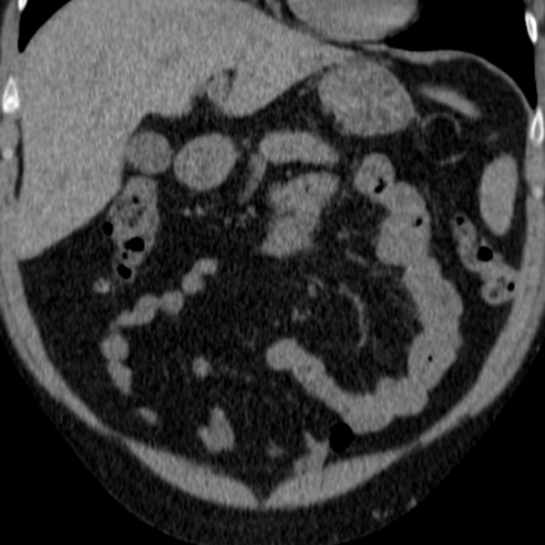File:Autosomal dominant polycystic kidney disease (Radiopaedia 36539-38101 Coronal non-contrast 1).jpg