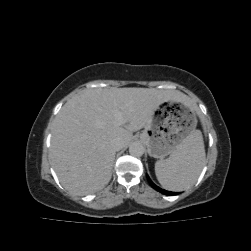 File:Autosomal dominant polycystic kidney disease (Radiopaedia 38189-40194 Axial C+ delayed 6).jpg