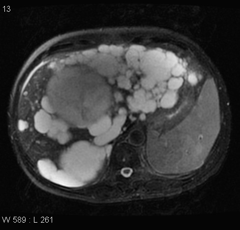 File:Autosomal dominant polycystic kidney disease (Radiopaedia 5202-6969 Axial T2 fat sat 4).jpg