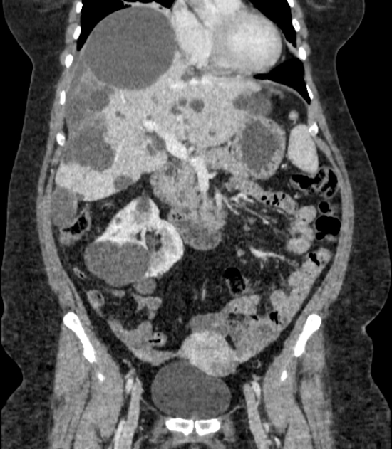 Autosomal dominant polycystic kidney disease (Radiopaedia 57124-64017 B 32).jpg