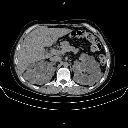 File:Autosomal dominant polycystic kidney disease (Radiopaedia 87830-104287 Axial non-contrast 18).jpg