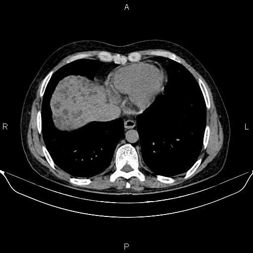 Autosomal dominant polycystic kidney disease (Radiopaedia 87830-104287 Axial non-contrast 7).jpg