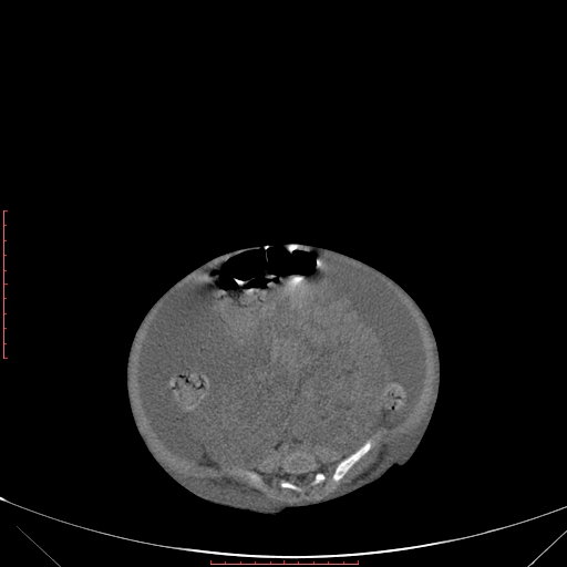 Autosomal recessive polycystic kidney disease associated with Caroli disease (Radiopaedia 61932-69984 B 265).jpg