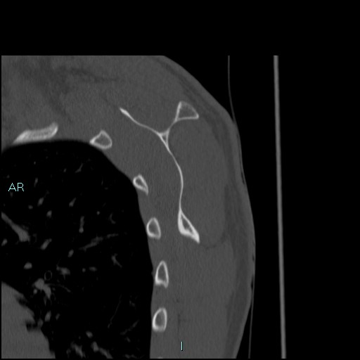 Avascular necrosis after fracture dislocations of the proximal humerus (Radiopaedia 88078-104653 Sagittal bone window 61).jpg