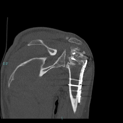 Avascular necrosis after fracture dislocations of the proximal humerus (Radiopaedia 88078-104655 Coronal bone window 69).jpg