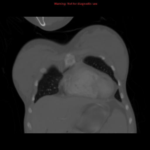 Avascular necrosis in sickle cell disease (Radiopaedia 17448-17152 Coronal bone window 24).jpg