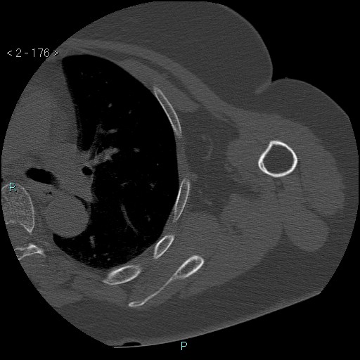 Avascular necrosis of the shoulder - Cruess stage I (Radiopaedia 77674-89887 Axial bone window 44).jpg