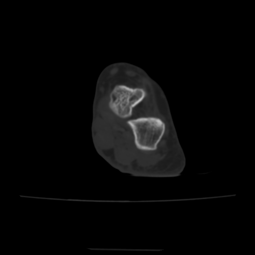 Avulsion fracture of the dorsal cuboid bone (Radiopaedia 51586-57377 Axial bone window 49).jpg