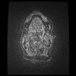Balo concentric sclerosis (Radiopaedia 53875-59982 Axial LAVA C+ 275).jpg