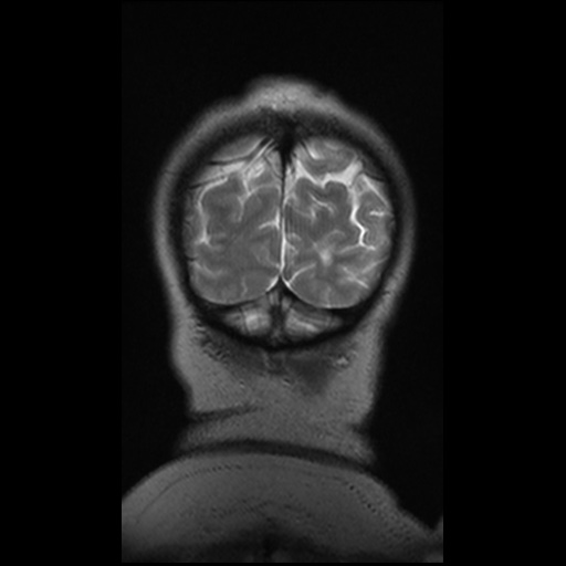 Balo concentric sclerosis (Radiopaedia 53875-59982 Coronal T2 10).jpg