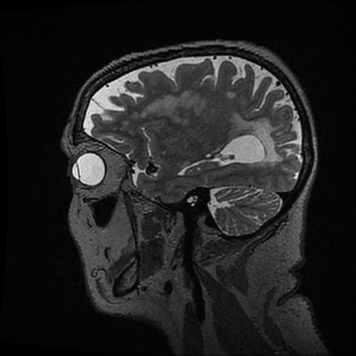 Balo concentric sclerosis (Radiopaedia 53875-59982 Sagittal 3D FSE 77).jpg