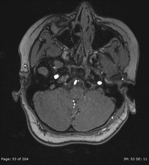 Balo concentric sclerosis (Radiopaedia 61637-69636 Axial MRA 53).jpg