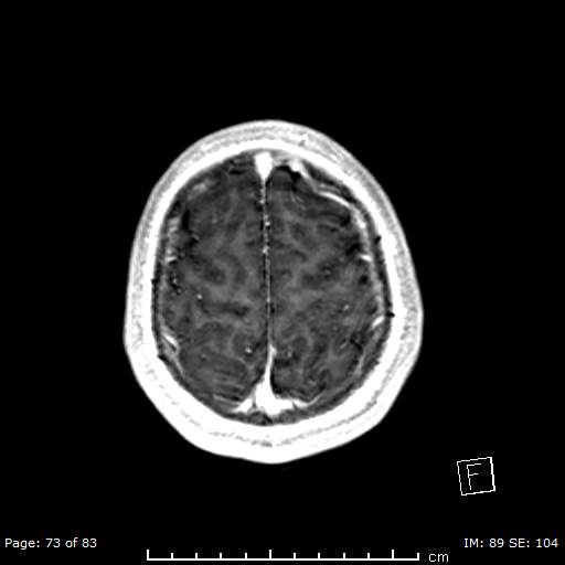 Balo concentric sclerosis (Radiopaedia 61637-69636 Axial T1 C+ 73).jpg