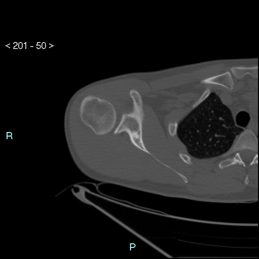 Bankart lesion with glenoid bone defect - assessment TC with PICO method (Radiopaedia 42855-93901 Axial bone window 49).jpg
