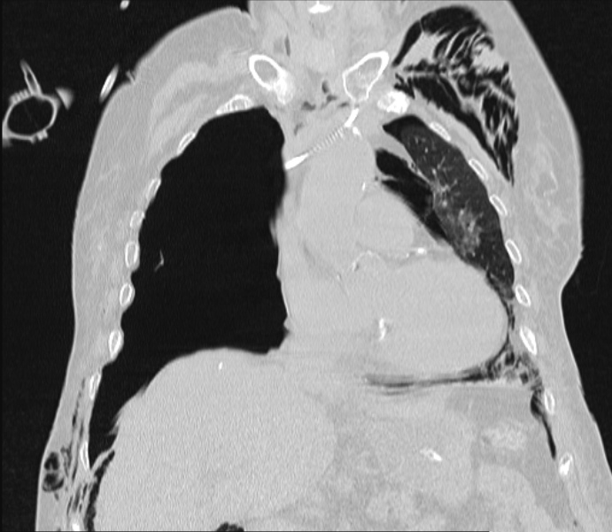 Barotrauma due to mechanical ventilation (Radiopaedia 28079-28336 Coronal lung window 41).jpg