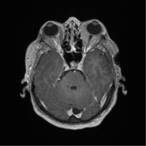 Basal ganglia metastasis (Radiopaedia 78928-91828 Axial T1 C+ 21).png