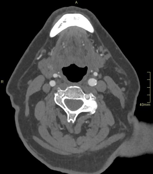 Basilar artery aneurysm (Radiopaedia 56261-62932 A 1).jpg