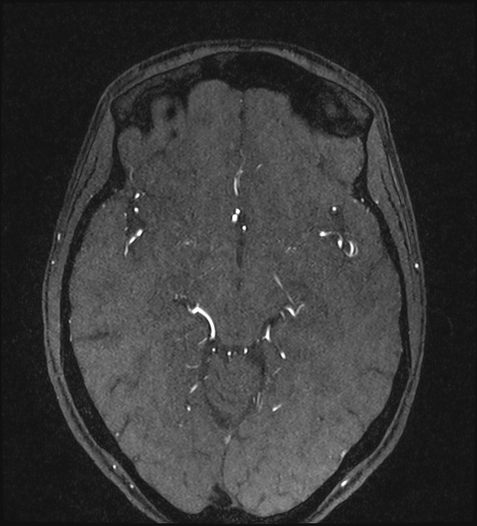 Basilar artery perforator aneurysm (Radiopaedia 82455-97733 Axial MRA 114).jpg